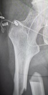 Broken thigh bone due to bone loss from osteoporosis in 40s