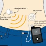 Diabetes Helping Implants