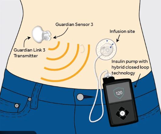 Diabetes Helping Implants